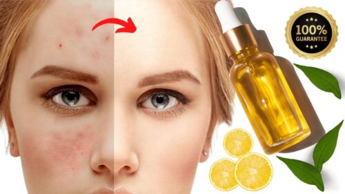 Vitamin C Serum for Acne-Free Skin