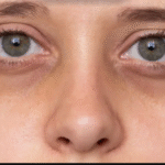 Treat Dark Circles and Pigmentation