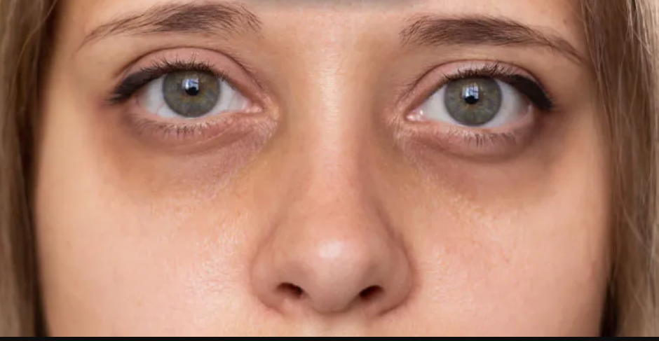 Treat Dark Circles and Pigmentation