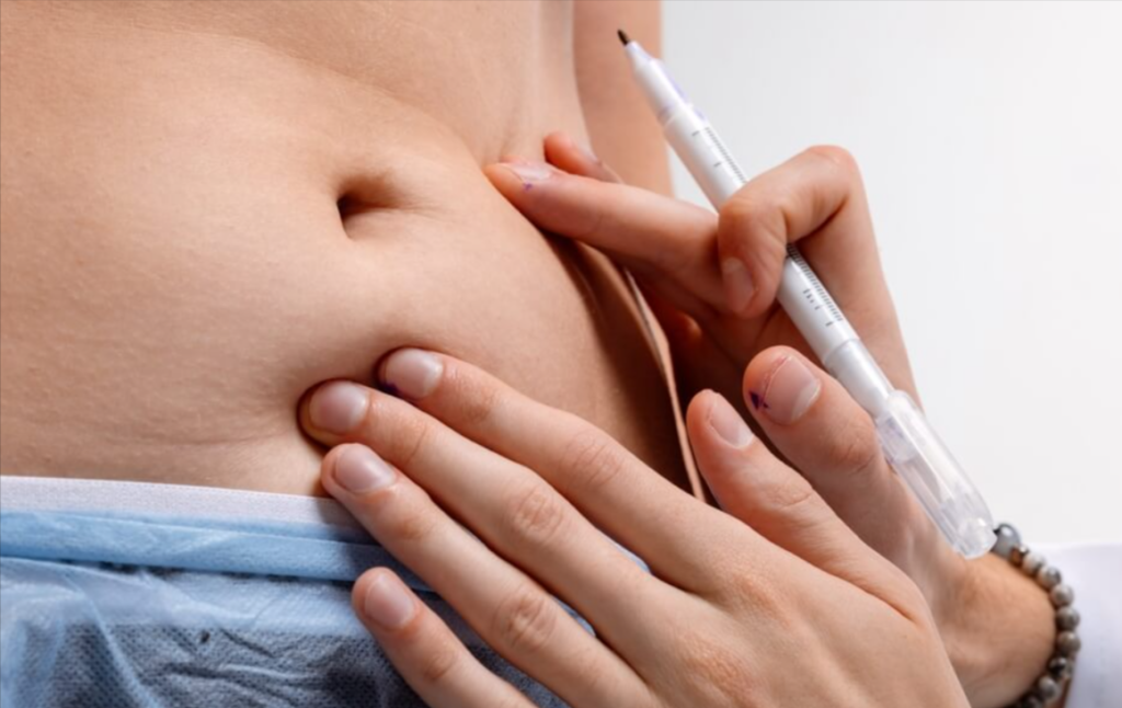 Guide to Liposuction in Dubai