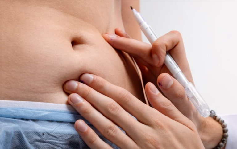 Guide to Liposuction in Dubai